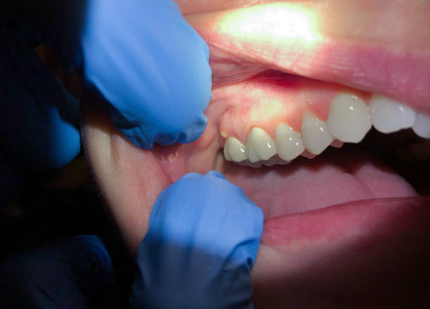 Best Emergency Root Canal Therapy in Woodmoor, CO